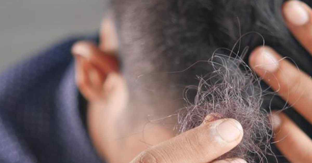 Perda de cabelo